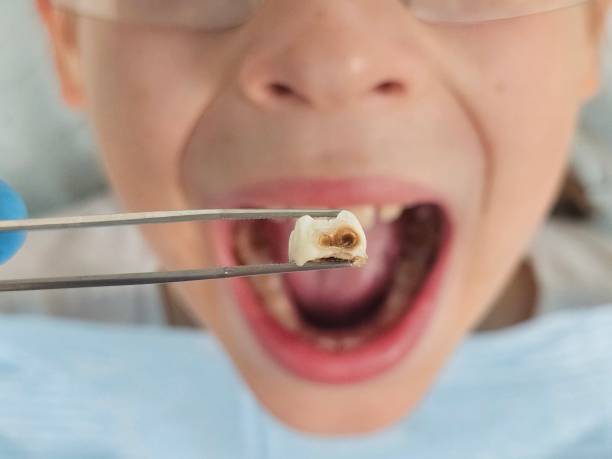 Best Emergency Treatment for Toothache in Pquemine, LA